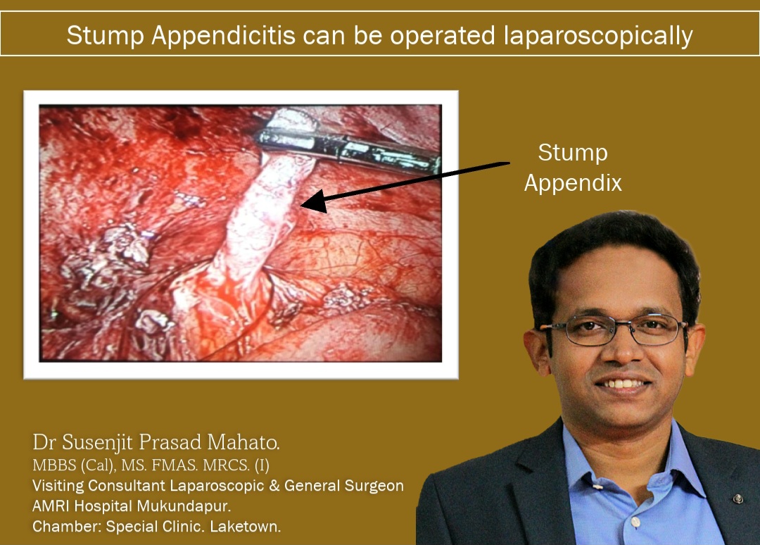 stump appendicitis