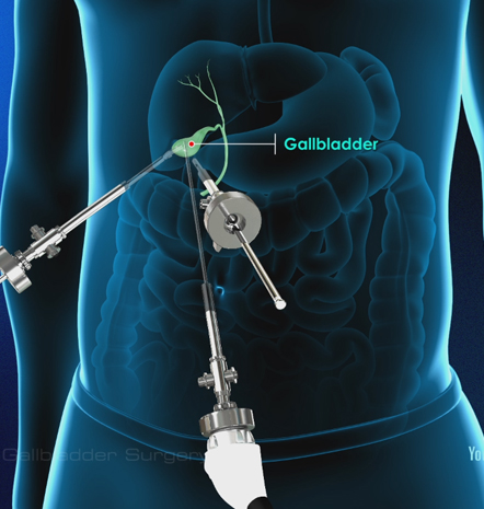 Laparoscopic Gallbladder Surgery - Dr. S.P Mahato