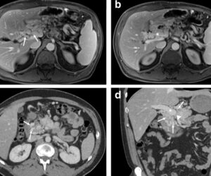 gallbladder duplication