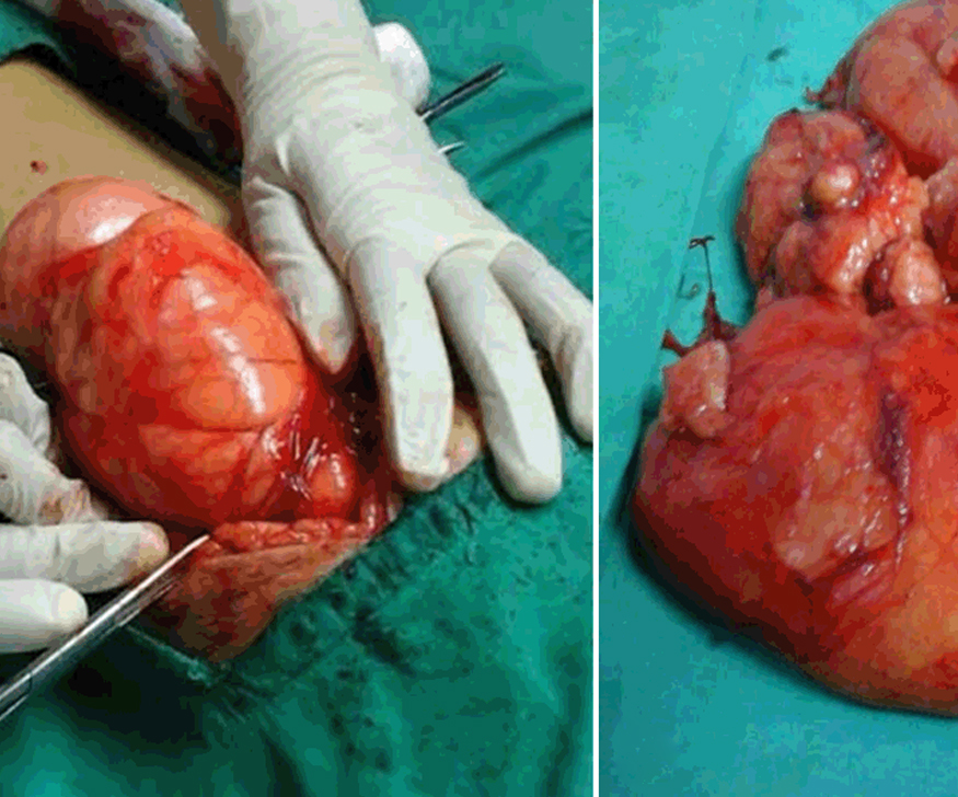 lipoma surgery in Kolkata by dr sp mahato